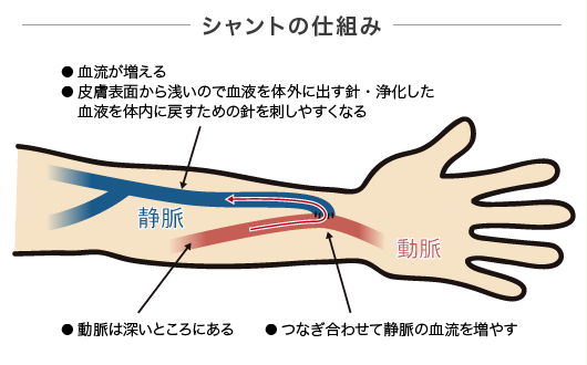 タ バチ エール シャント と は